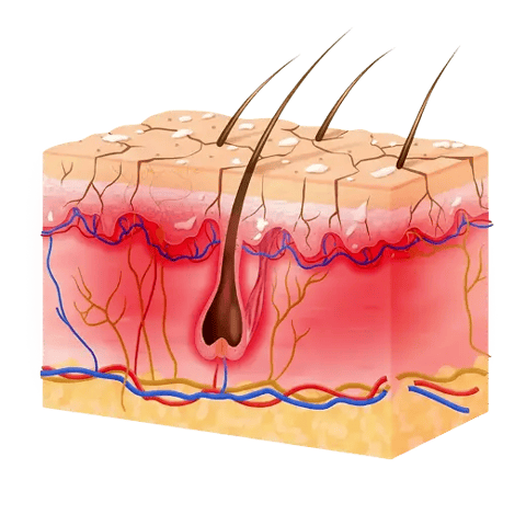 Illustration of a dry, irritated scalp barrier